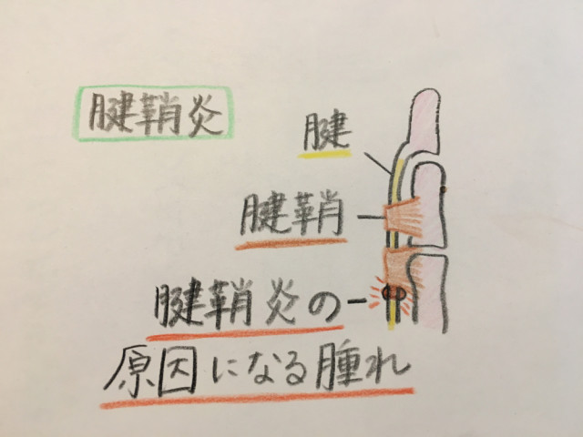 腱鞘炎とは?