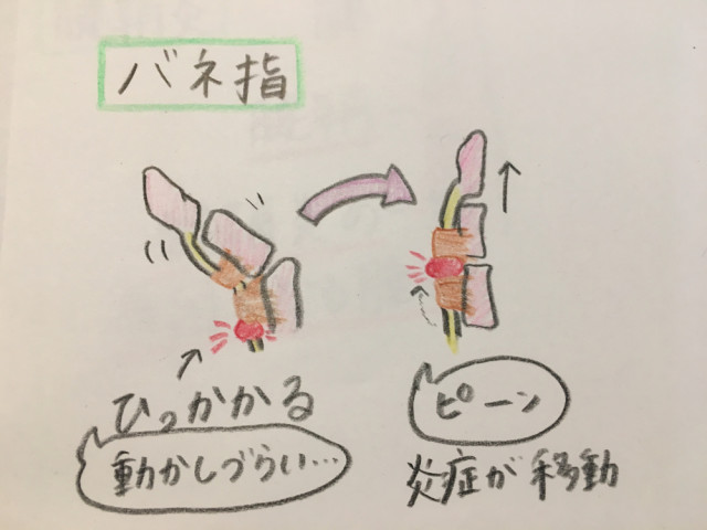 ばね指とは?